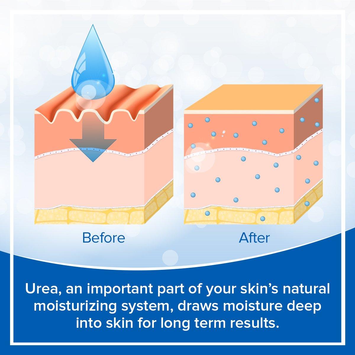 Heel Care Cream - Dermal Therapy™ 25% Urea, 6% Alpha Hydroxy Acids, AHA, dehydrated skin, dermaltherapy, diabetes, diabetic dry skin, diabetic neuropathy, dry cracks, dry heels, dry skin, fragrance-free, heel, Moisturizer, non-greasy, Silk amino acids, urea Cream 25% Urea, 6% Alpha Hydroxy Acids, AHA, dehydrated skin, dermaltherapy, diabetes, diabetic dry skin, diabetic neuropathy, dry cracks, dry heels, dry skin, fragrance-free, heel, Moisturizer, non-greasy, Silk amino acids, urea