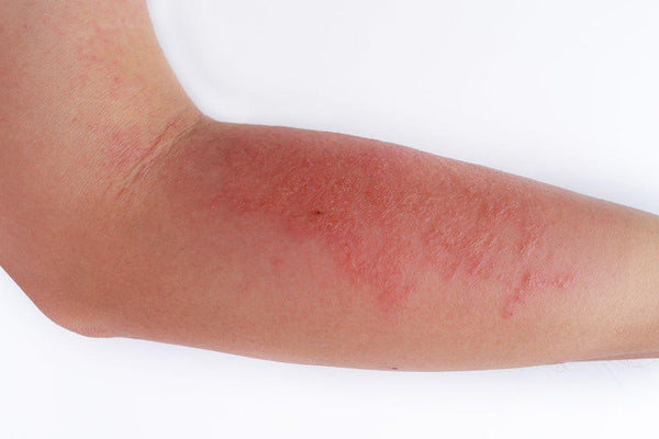 Atopic Dermatitis - Dermal Therapy™   {{ product.product_type }}