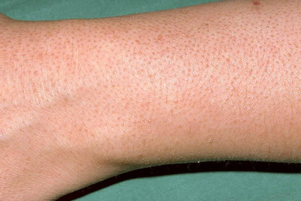Hyperkeratosis (Keratosis Pilaris) - Dermal Therapy™   {{ product.product_type }}